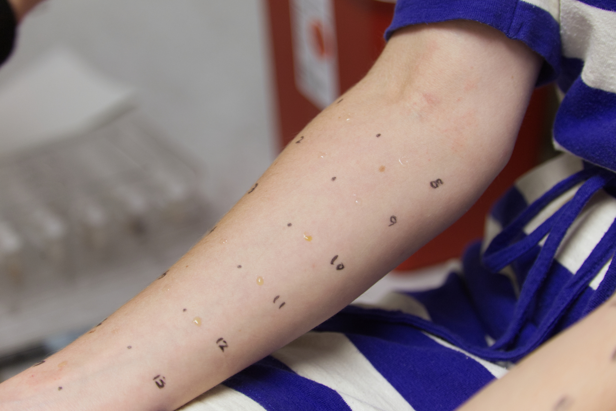 Intradermal allergy testing being administered