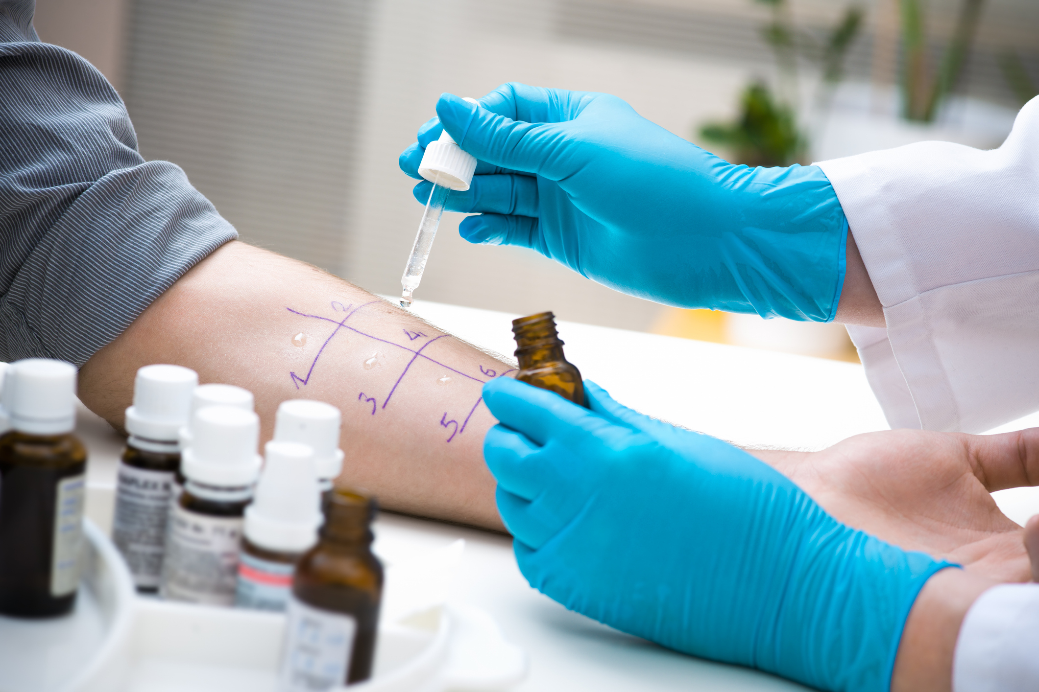 Skin prick allergy testing on a patient's forearm